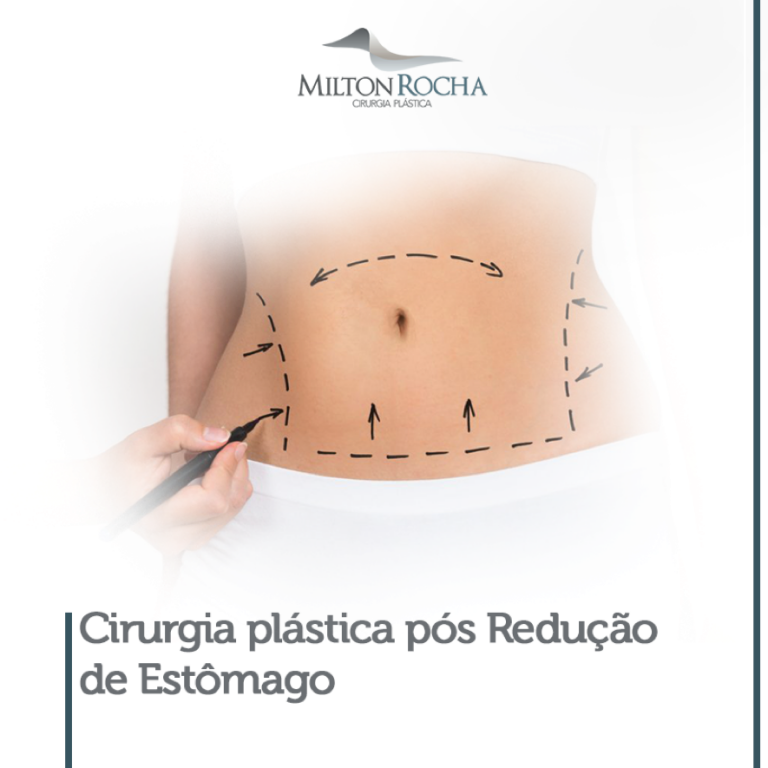 Read more about the article Cirurgia plástica após Gastroplastia