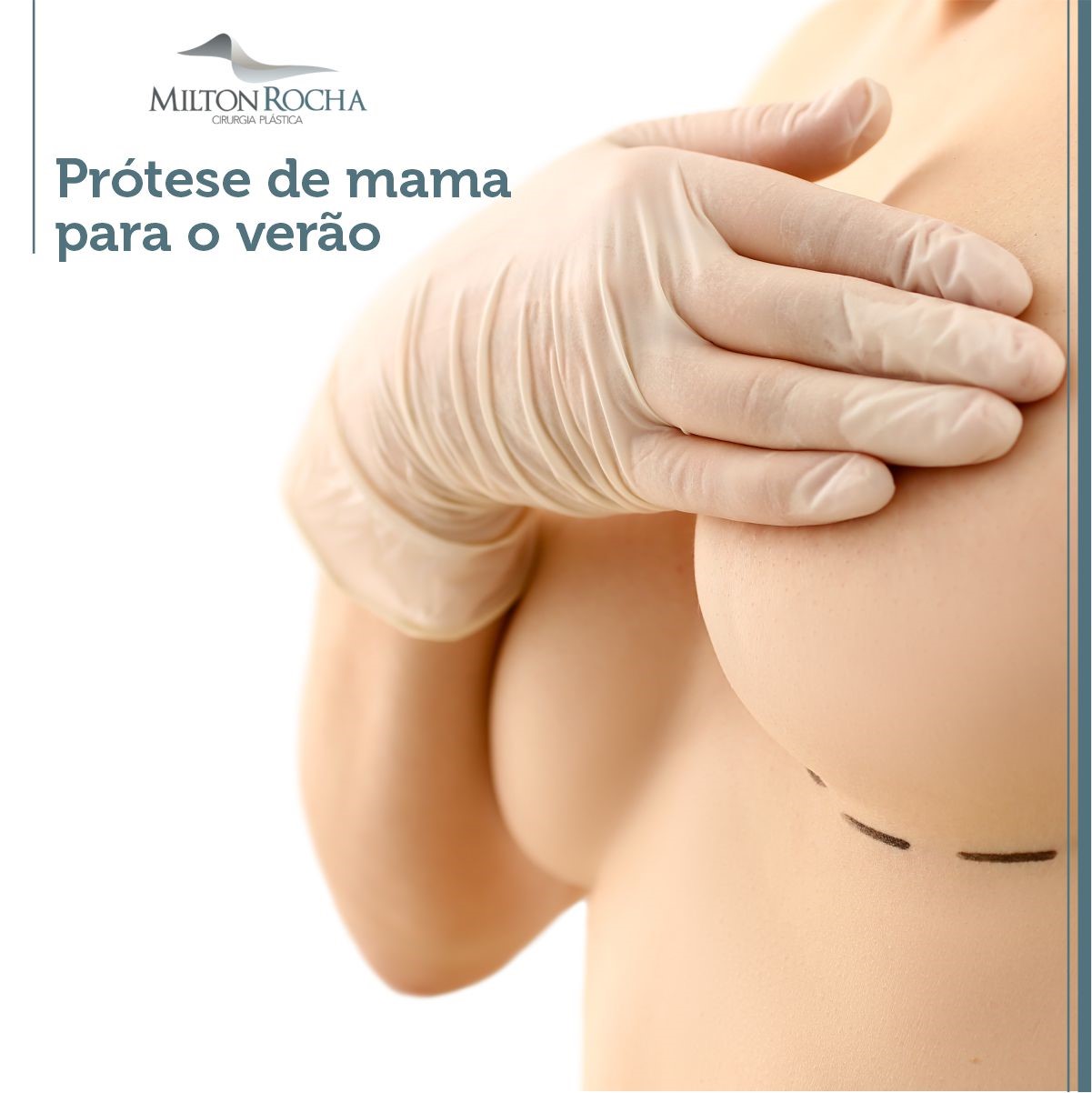 Read more about the article Prótese de mama para o verão