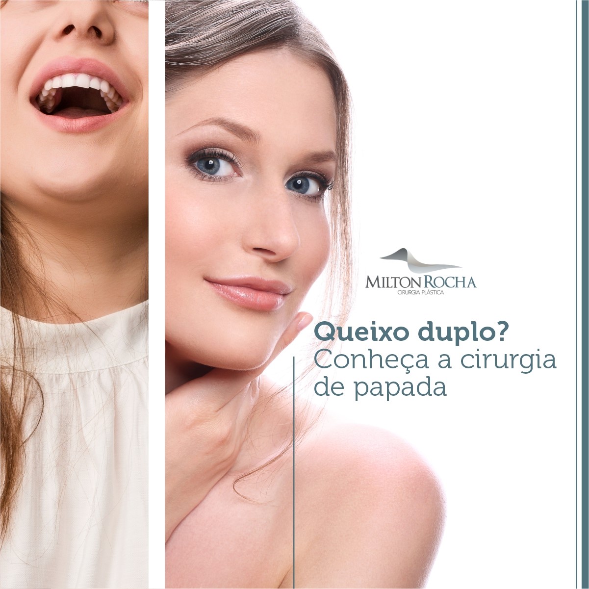 Read more about the article Queixo duplo? Conheça a cirurgia de papada