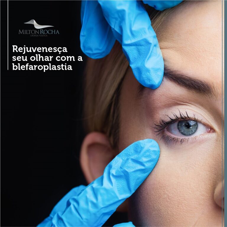 Read more about the article Cirurgia Plástica Recife – Rejuvenesça seu olhar com a blefaroplastia