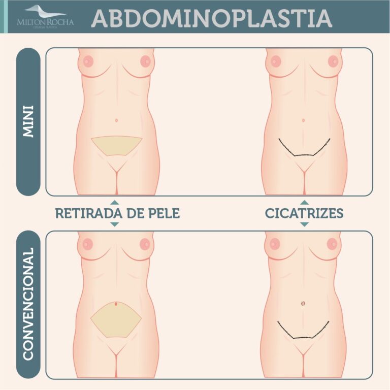 Read more about the article Cirurgia Plástica Recife | Abdominoplastia