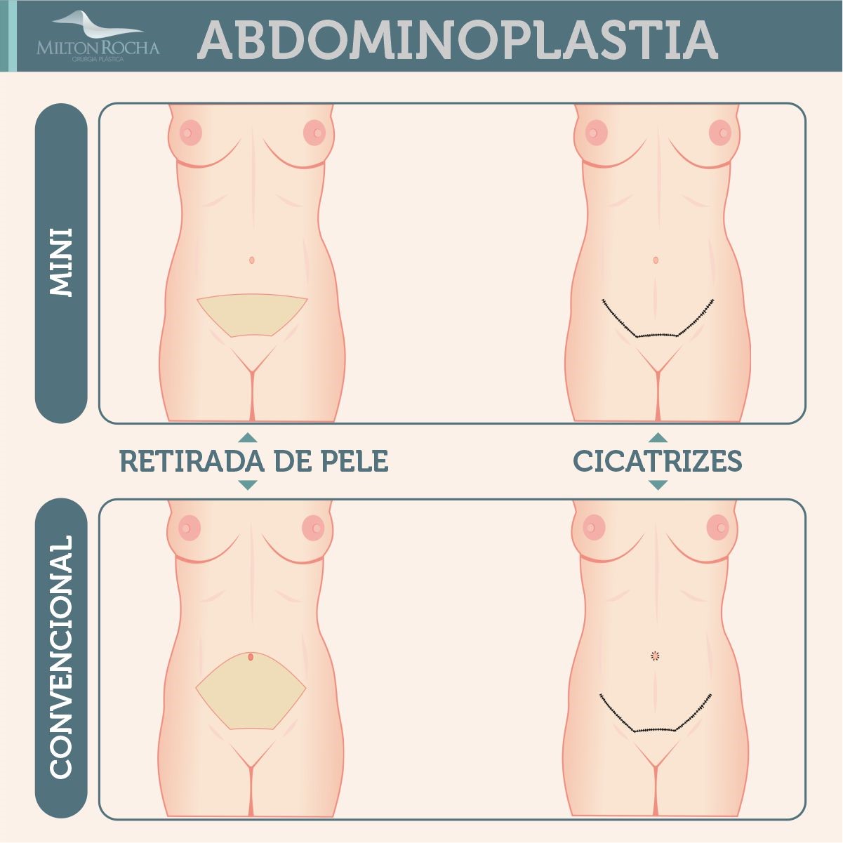 You are currently viewing Cirurgia Plástica Recife | Abdominoplastia