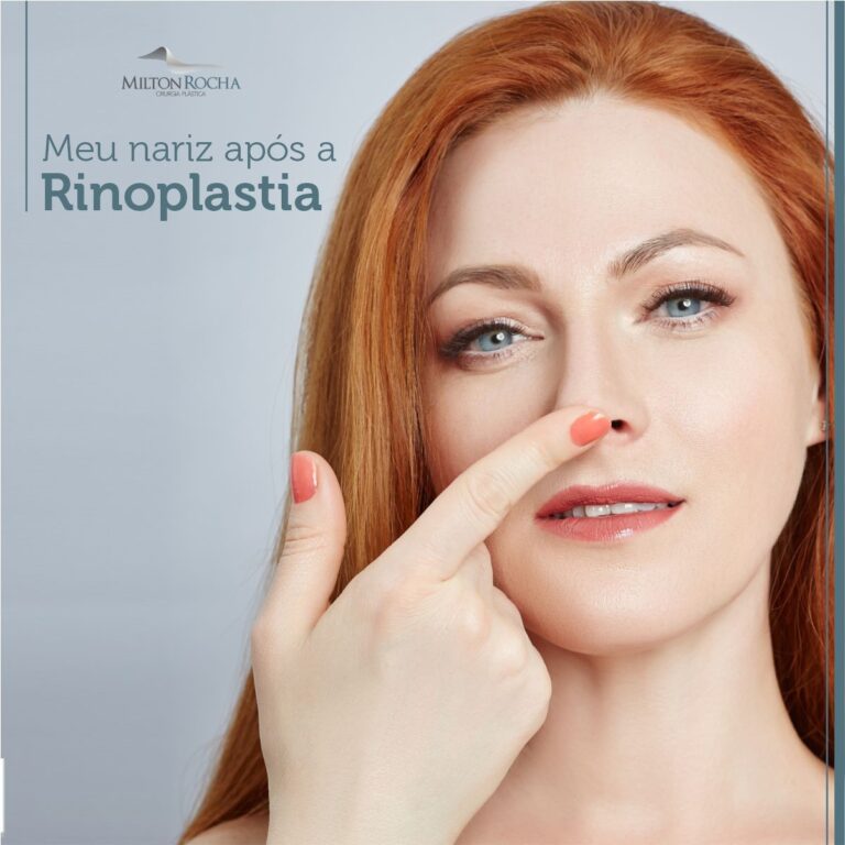 Read more about the article Meu nariz após a Rinoplastia