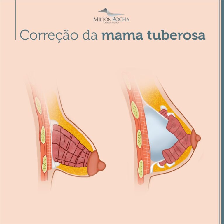 Read more about the article Cirurgia Plástica Recife – Correção da mama tuberosa