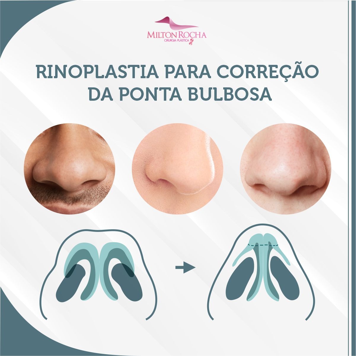 Read more about the article Cirurgia Plástica Recife – Rinoplastia para correção da ponta bulbosa