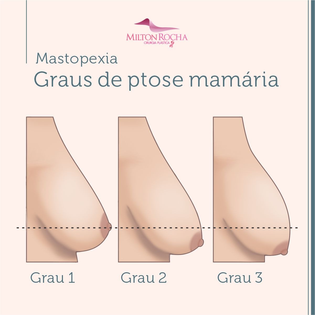 Read more about the article Cirurgia Plástica Recife – Graus de ptose mamária