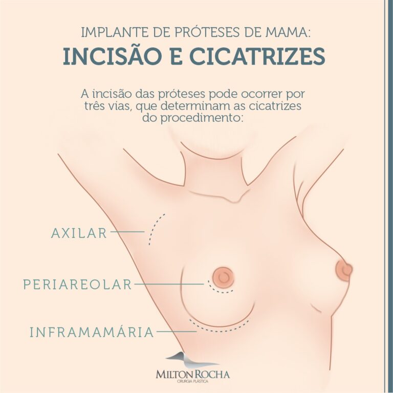 Read more about the article Cirurgia Plástica Recife – Implante de próteses de mama: Incisão e cicatrizes