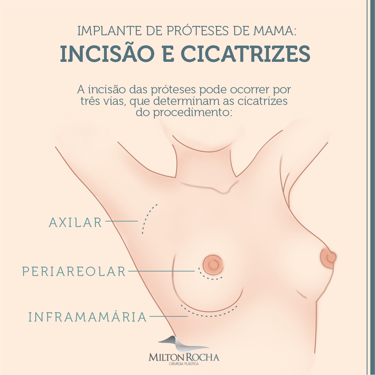 Read more about the article Cirurgia Plástica Recife – Implante de próteses de mama: Incisão e cicatrizes