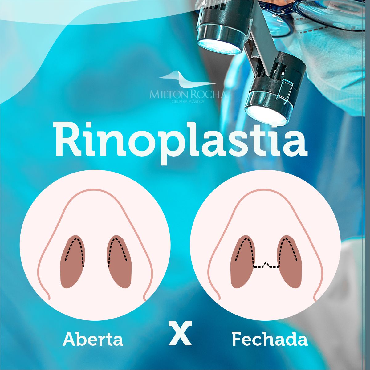 Read more about the article Cirurgia Plástica Recife – Rinoplastia