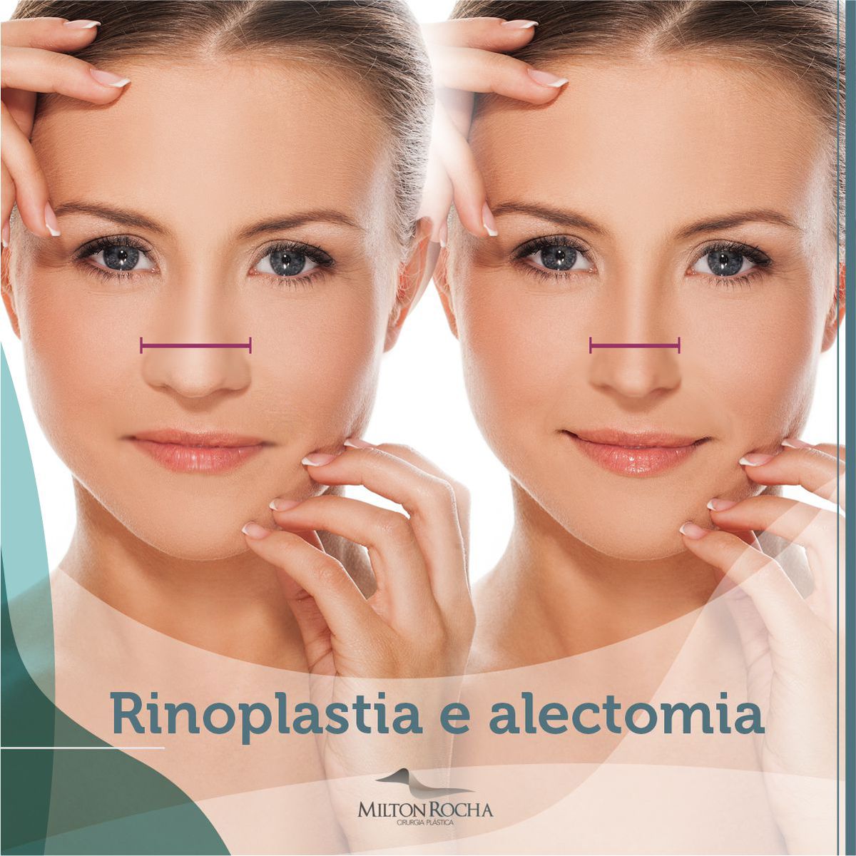 Read more about the article Cirurgia Plástia Recife – Rinoplastia e Alectomia