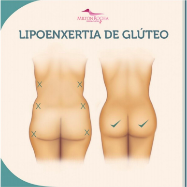 Read more about the article Lipoenxertia de Glúteos
