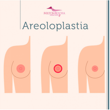 Read more about the article Cirurgia Plástica Recife – Areoloplastia