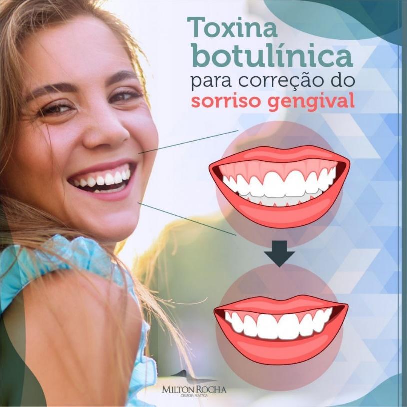 Read more about the article Cirurgia Plástica Recife – Toxina Butolínica para correção do sorriso gengival