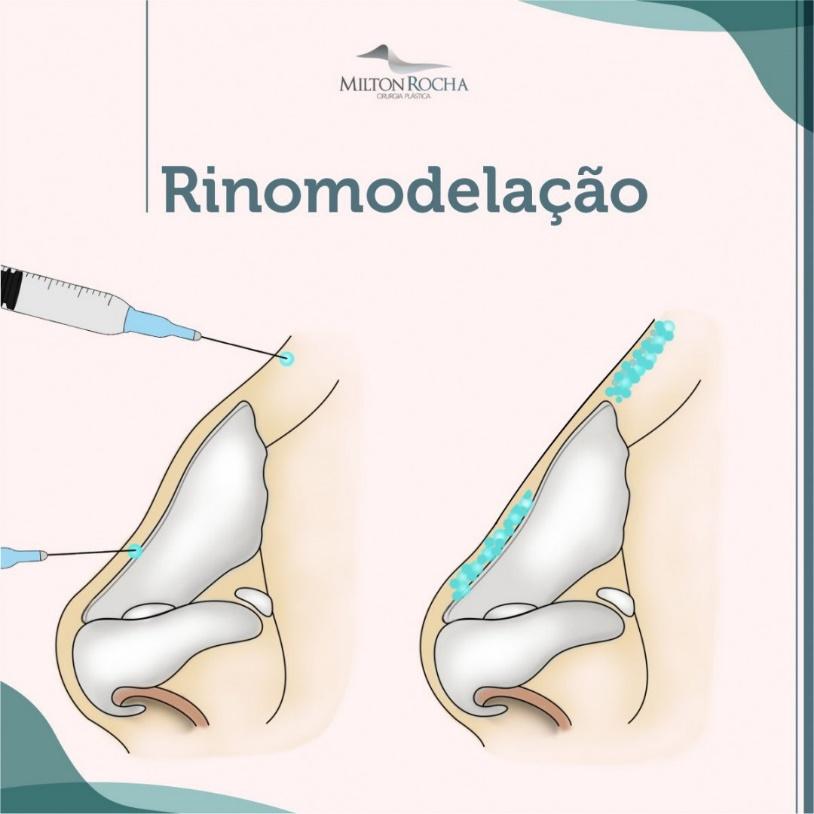 Read more about the article Cirurgia Plástica Recife – Rinomodelação