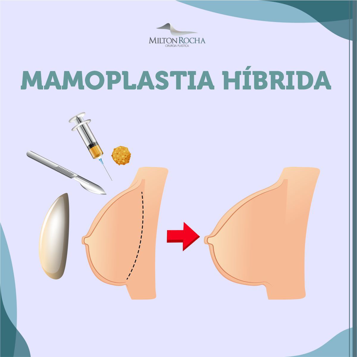 Read more about the article Cirurgia Plástica Recife – Mamoplatia híbrida