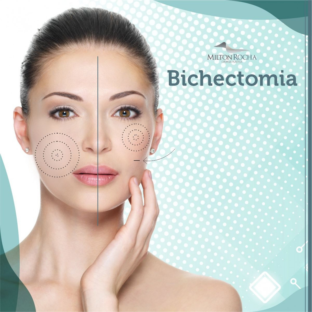 Read more about the article Cirurgia Plástica Recife – Bichectomia