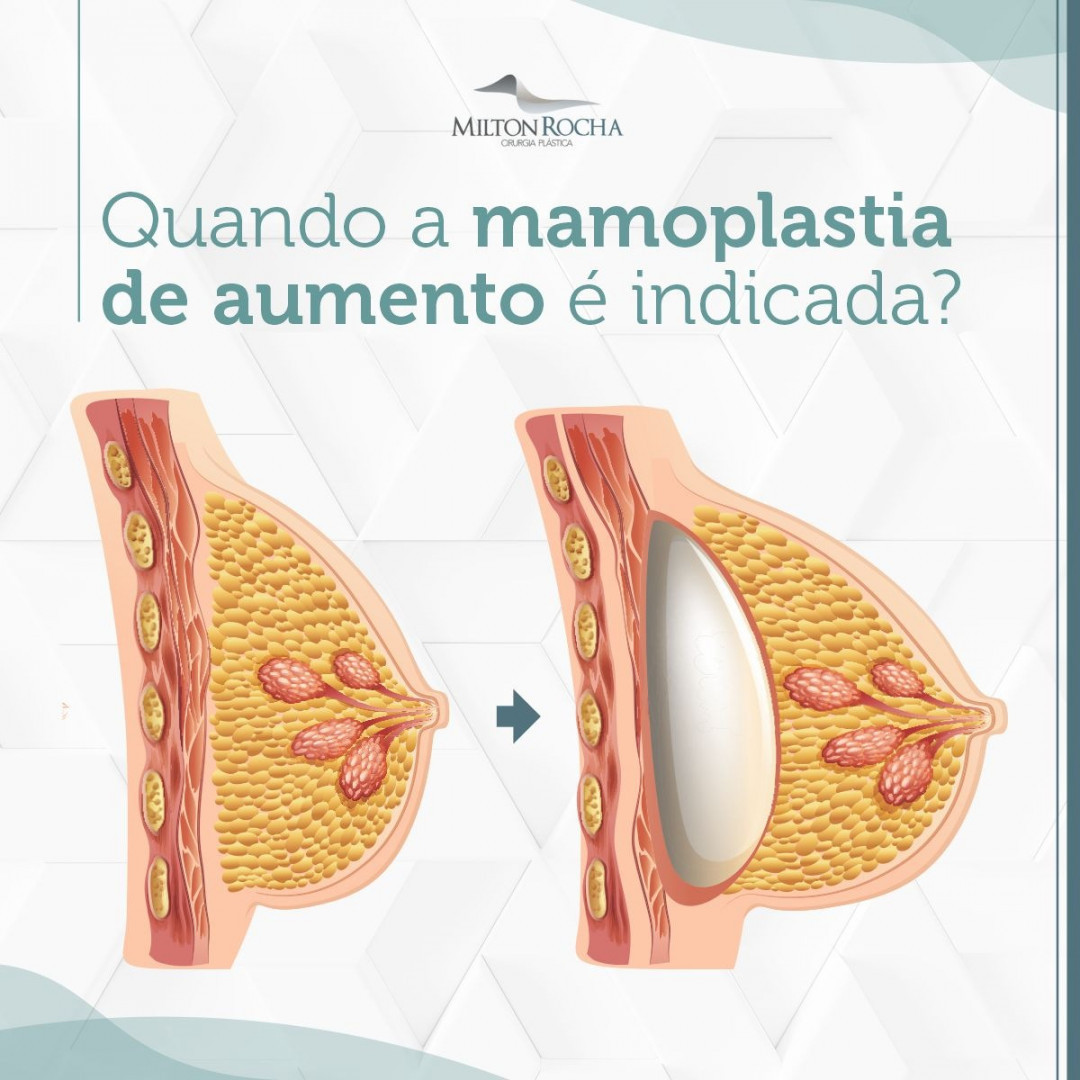 You are currently viewing Cirurgia Plástica Recife – Quando a mamoplastica de aumento é indicada?