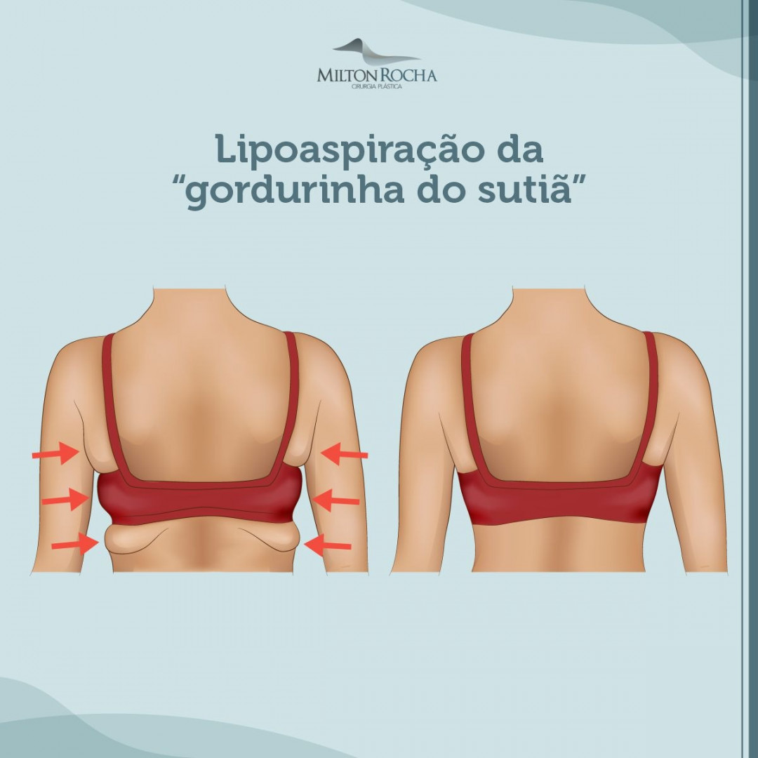 You are currently viewing Cirurgia Plástica Recife – Lipoaspiração da “gordurinha do sutiã”