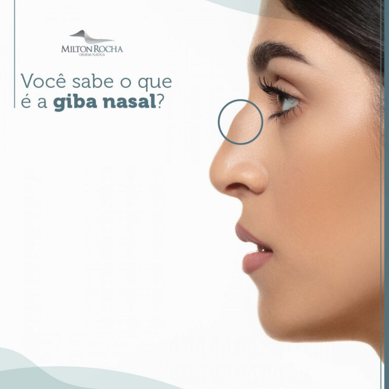 Read more about the article Cirurgia Plástica Recife – Você sabe o que é a GIBA nasal?
