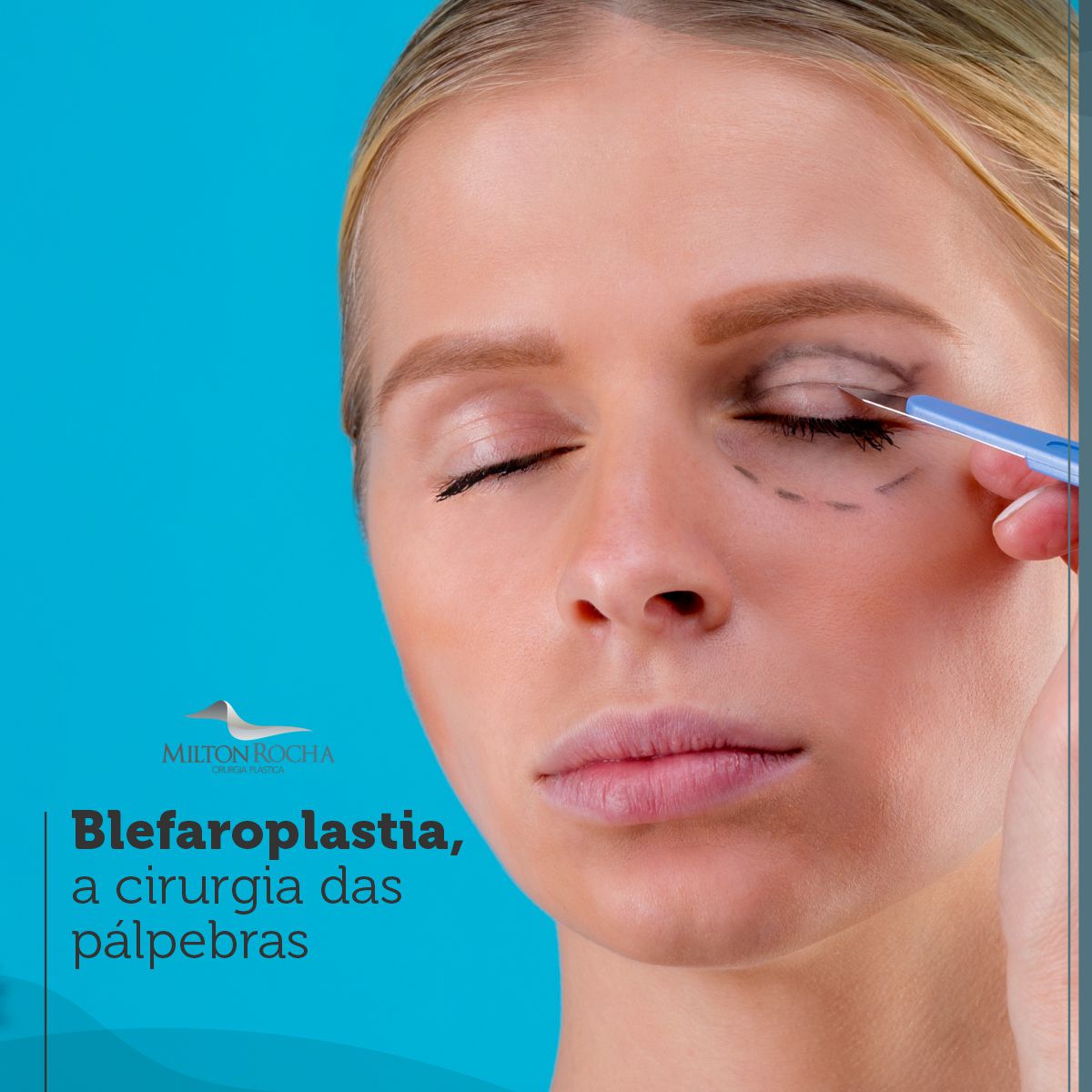 You are currently viewing Cirurgia Plástica Recife – Blefaroplastia, a cirurgia das pálpebras