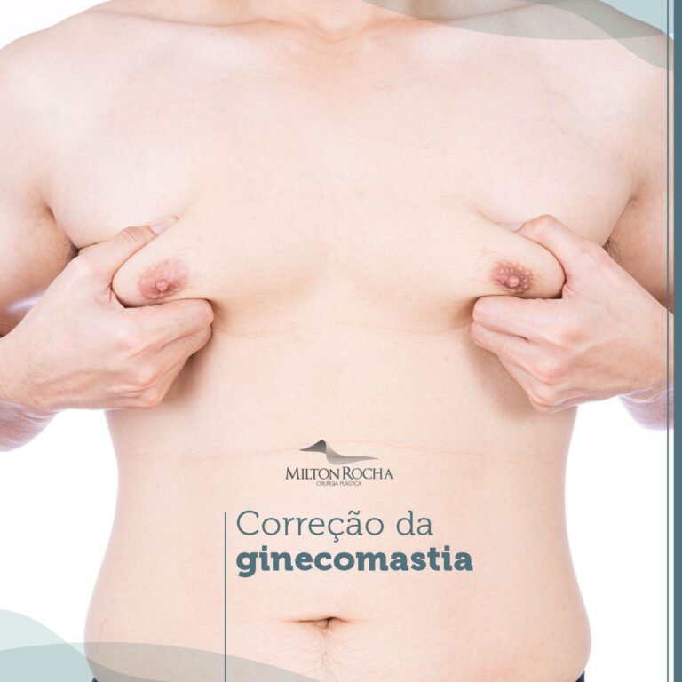 Read more about the article Cirurgia Plástica Recife – Correção da Ginecomastia
