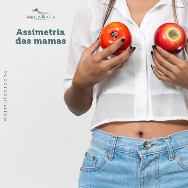 Read more about the article Cirurgia Plástica Recife – Assimetria das Mamas