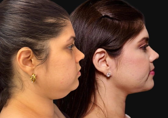 Cervicoplastia