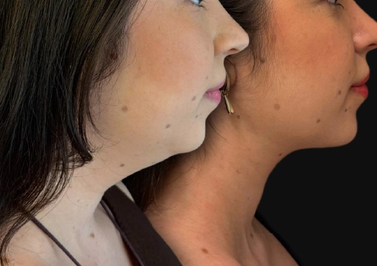 Deep Neck