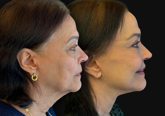 Deep Plane Facelift