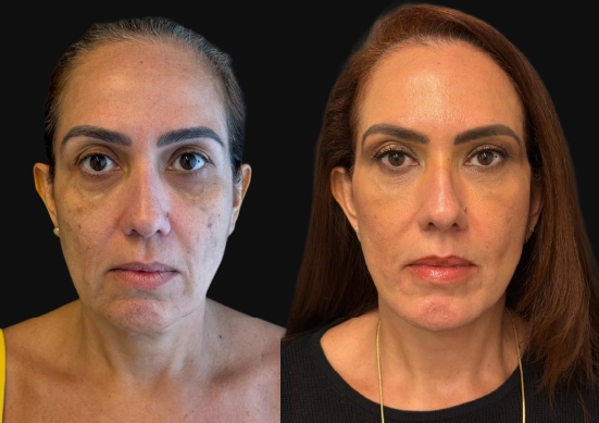 Lifting Facial