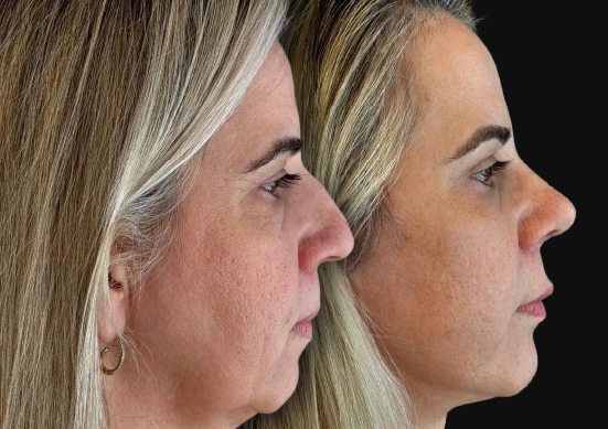 Rinoplastia