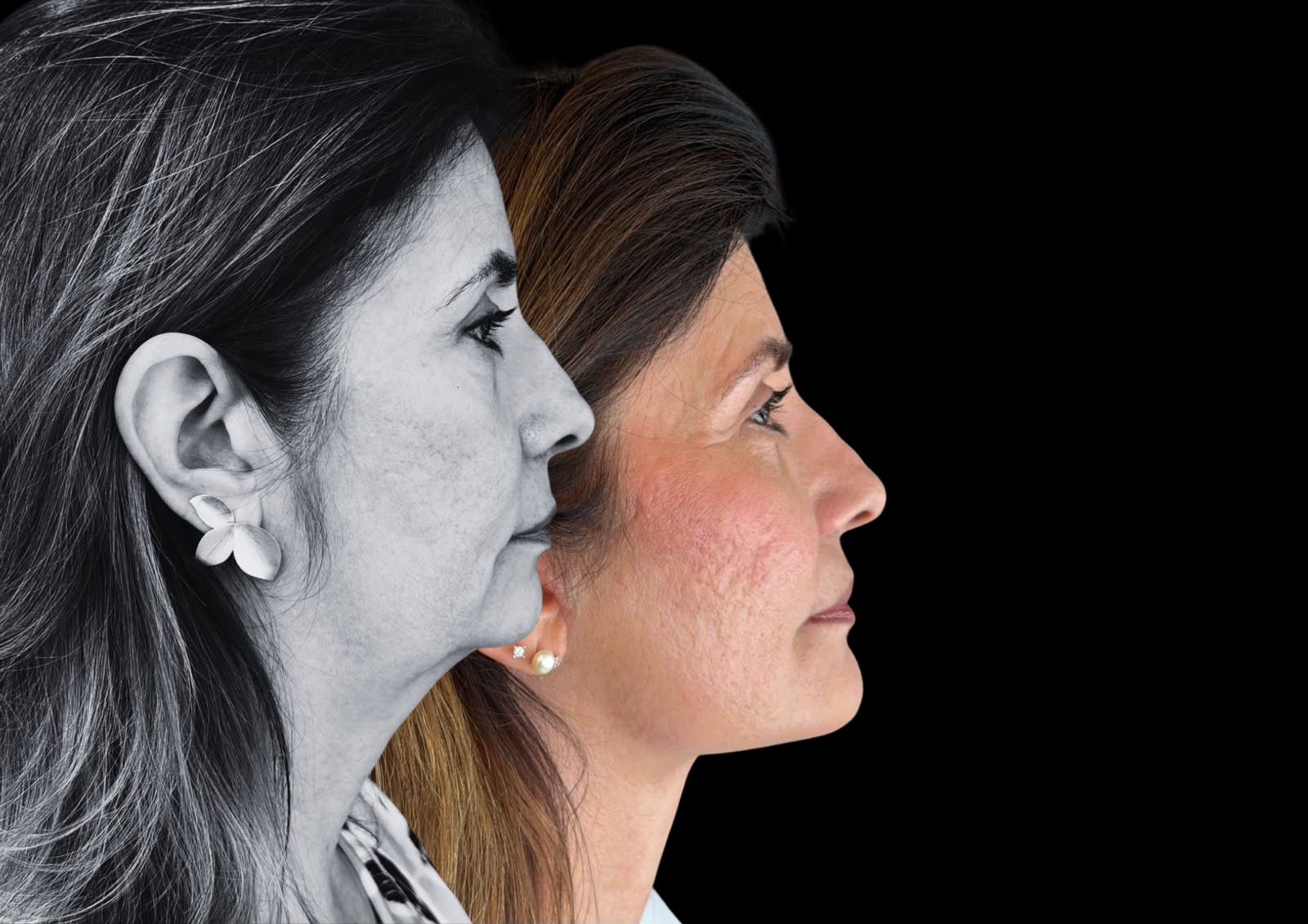 Lifting Facial